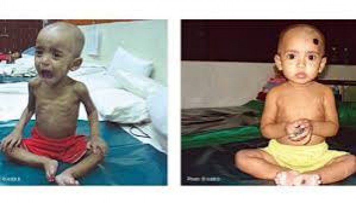 ছাতকে অপুষ্ট শিশু শনাক্তকরণ বিষয়ক প্রশিক্ষণ ছাতকে অপুষ্ট শিশু শনাক্তকরণ বিষয়ক প্রশিক্ষণ