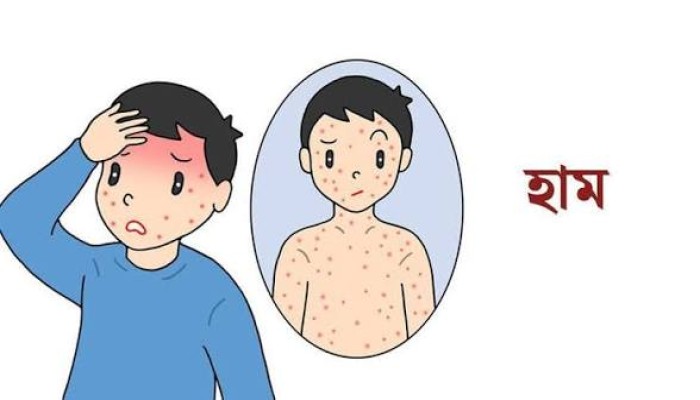 হাম উপসর্গে সুনামগঞ্জের দুই শিশুর মৃত্যু