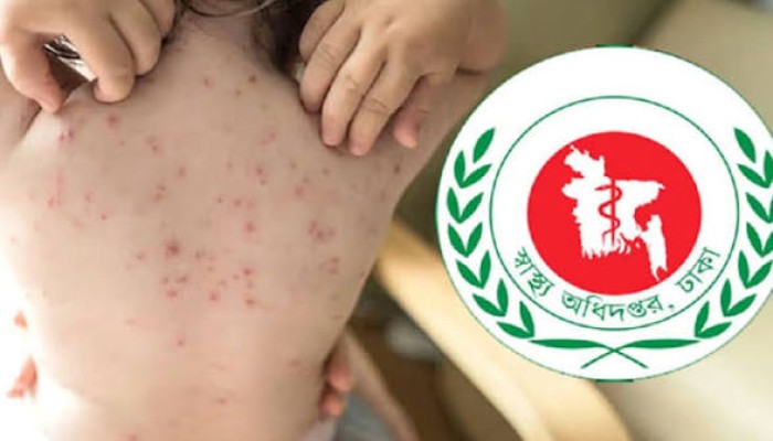 হামের দাপট থামছেই না, একদিনে আরও ৬ মৃত্যু