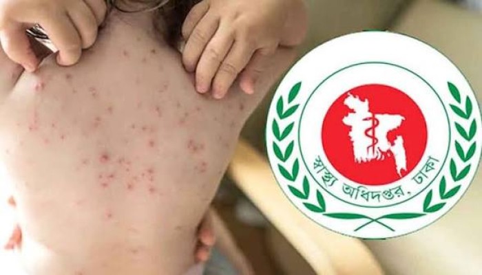 হাম উপসর্গে আরও দুই শিশুর মৃত্যু, সুনামগঞ্জে মৃতের সংখ্যা বেড়ে ৬৯